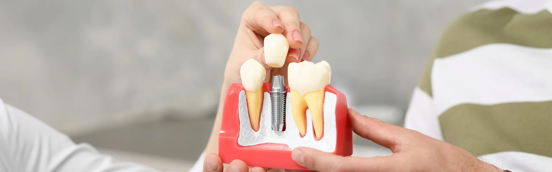 What are the 3 stages of dental implants