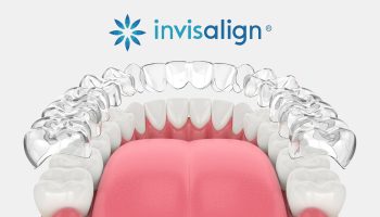 Invisalign in San Diego: What Patients Wish They Knew Before Starting
